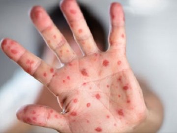 На Буковині 45 школярів та вагітна вчителька захворіли на кір