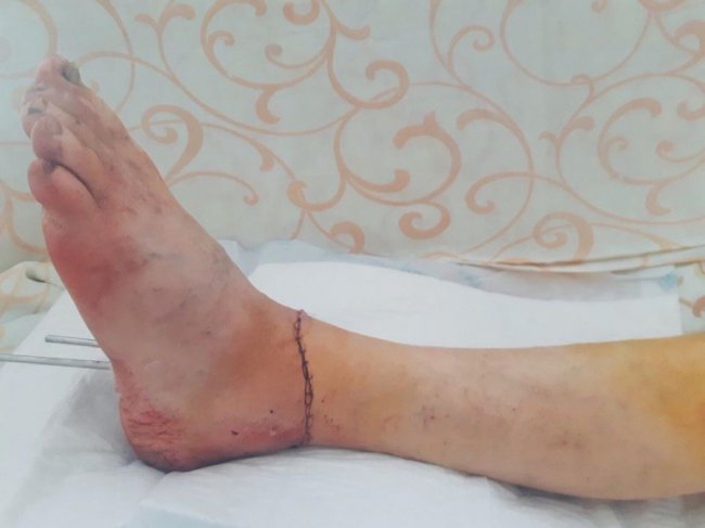 У луцькій лікарні вперше успішно пришили жінці ногу. ФОТО 18+