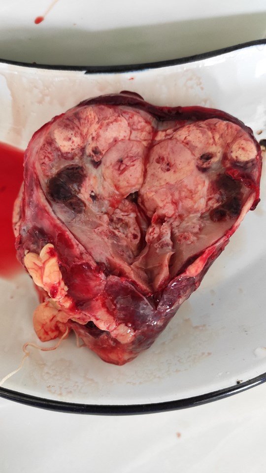 На Волині лікарі видалили пацієнту нирку, уражену величезною пухлиною. ФОТО 18+