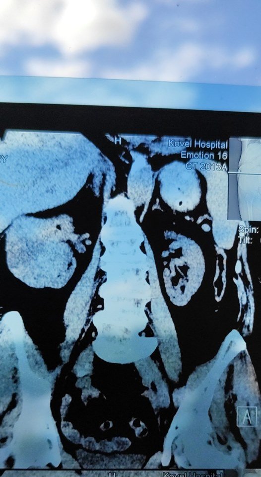 На Волині лікарі видалили пацієнту нирку, уражену величезною пухлиною. ФОТО 18+