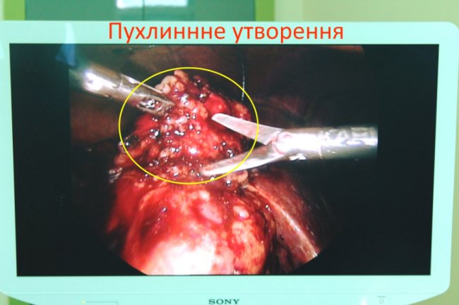 Волинські медики успішно видалили пухлину нирки без розрізів. ФОТО