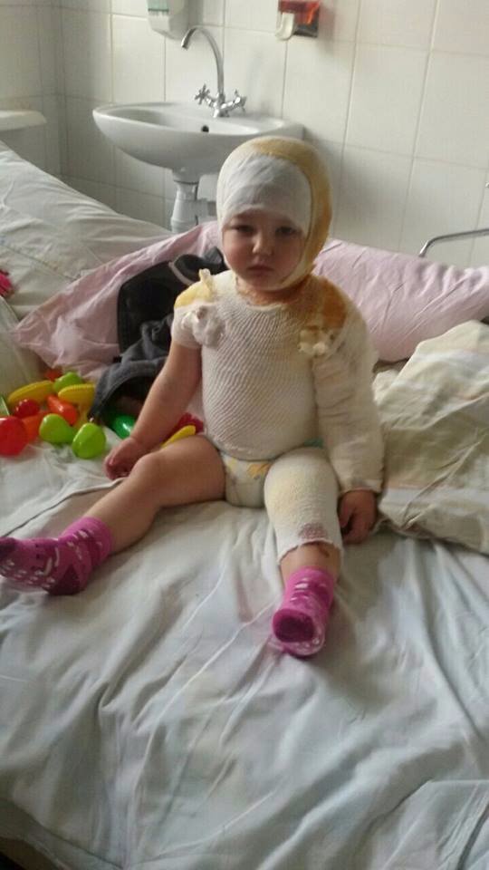 Маленькій лучанці, яка отримала важкі опіки, терміново потрібна допомога
