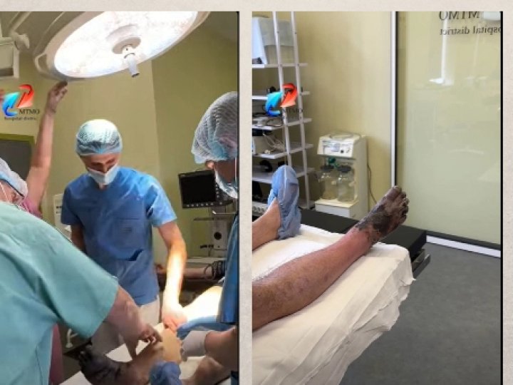 На Волині чоловіку ампутували ногу після обмороження