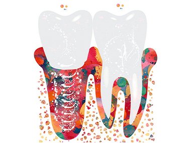 Імплантація зуба: не страшно, не боляче, на все життя