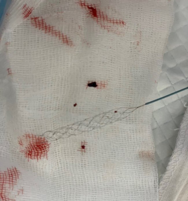 Вдалося запобігти ушкодженню мозку: у лікарні на Волині зробили дві унікальні операції 