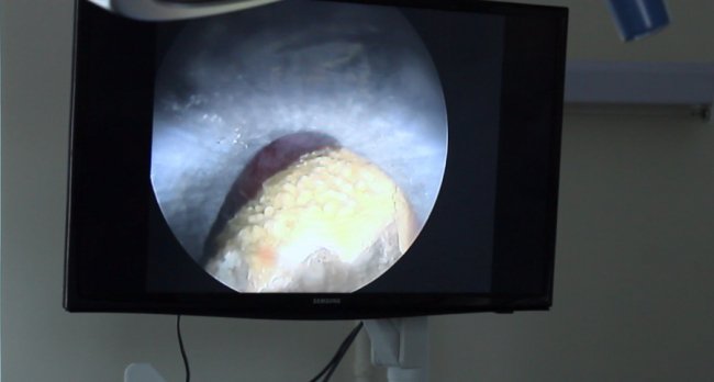 «Дробимо як горішки»: ковельські лікарі видалили величезний камінь з нирки