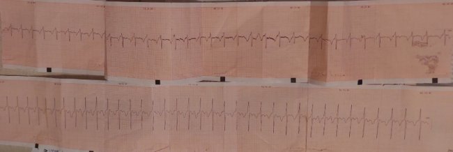 На Волині медики повернули до життя чоловіка після зупинки серця