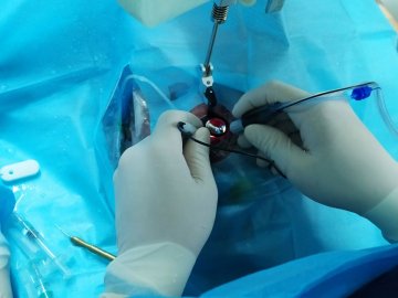 Волинянин під час роботи «загнав» у око великий шматок металу. ФОТО