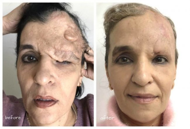 Відомий хірург з Волині врятував жінці обличчя після складної хвороби. ФОТО