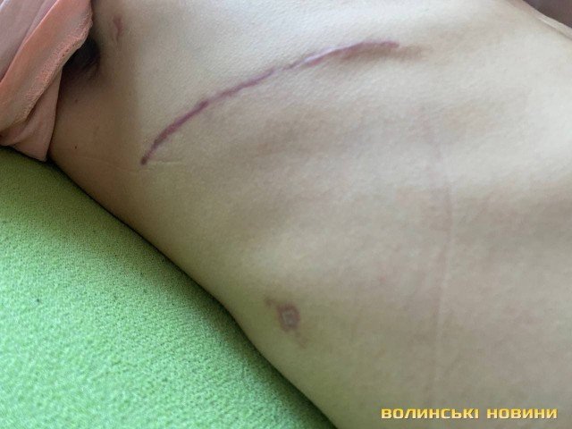 20-річний Семен Цикорський потребує коштів на дороговартісні медикаменти