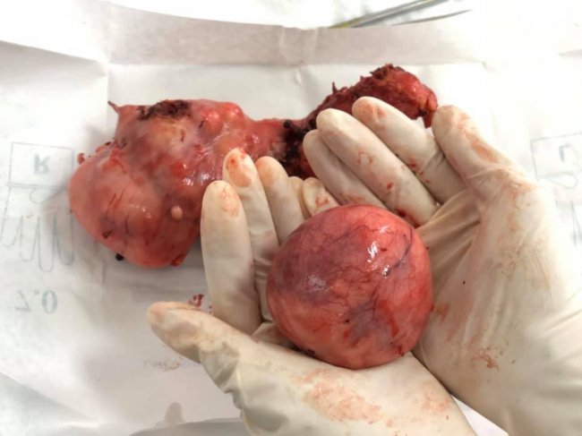 На Волині хірурги-гінекологи провели складну операцію жінці при невеликому розрізі