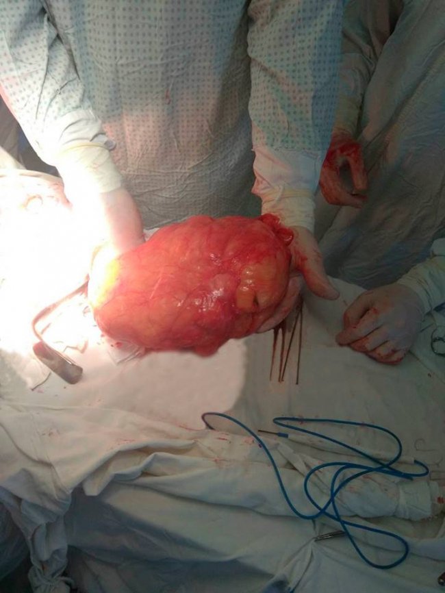 Волинські лікарі видалили жінці гігантську пухлину. ФОТО 18+