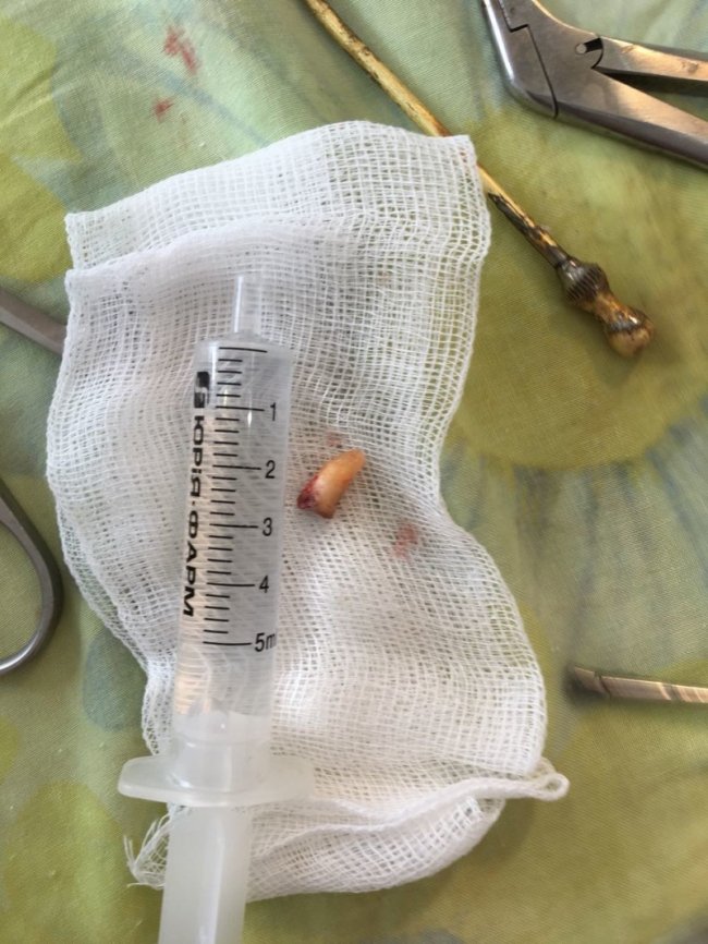 Луцькі лікарі дістали у жінки шматок зуба з пазухи носа. ФОТО