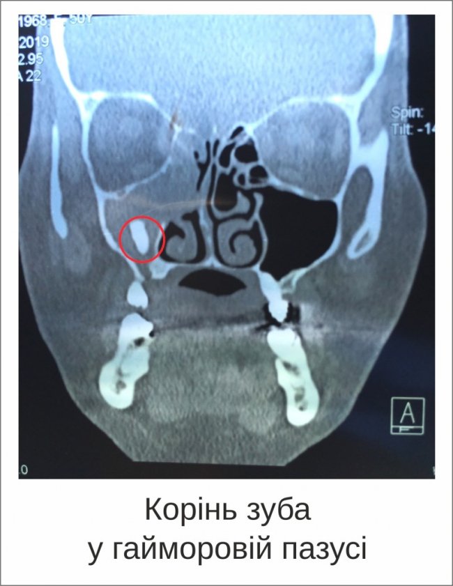 Луцькі лікарі дістали у жінки шматок зуба з пазухи носа. ФОТО
