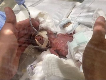 Японські лікарі врятували немовля, яке народилося з вагою у 268 грамів. ФОТО