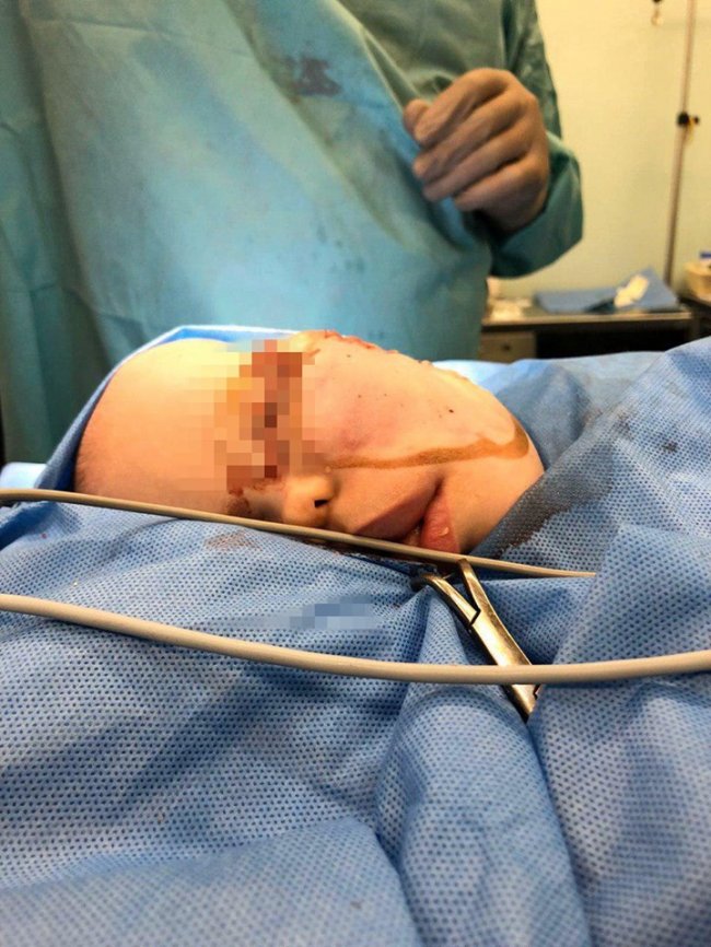 Хірург з Волині видалив з обличчя немовляти величезну пухлину. ФОТО