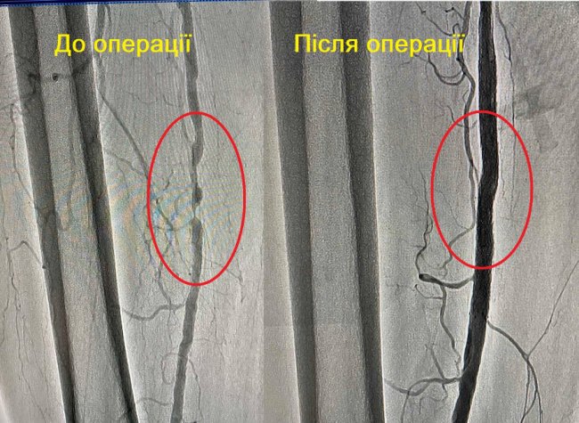 Волинські лікарі успішно прооперували чоловіка, який міг втратити ноги