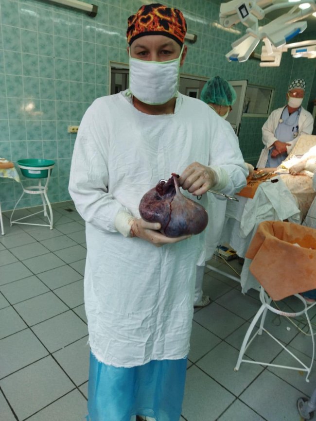 Луцькі лікарі видалили у жінки величезну пухлину, у якій було 4 л рідини.ФОТО18+