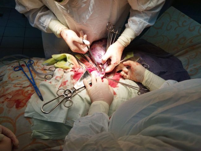 Луцькі лікарі видалили у жінки величезну пухлину, у якій було 4 л рідини.ФОТО18+