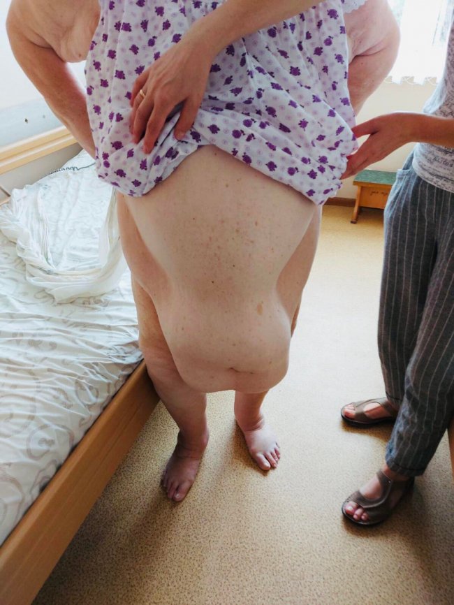 Луцькі хірурги видалили з живота жінки 15 кг жиру та шкіри.ФОТО