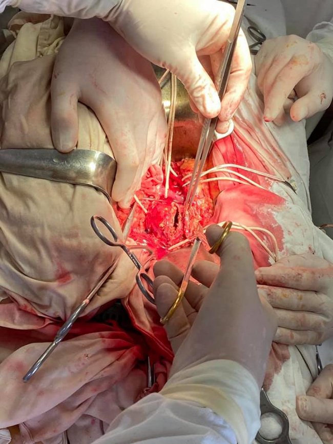 У Ковелі лікарі провели унікальну за складністю операцію, яка тривала 6 годин