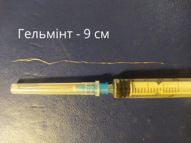 На Волині у жінки з ока дістали 9-сантиметрового гельмінта. ФОТО