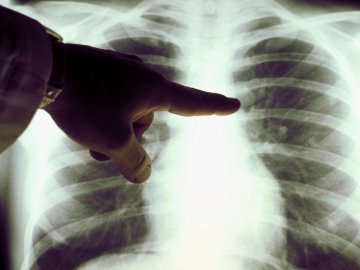 У Володимирі – 9 людей з пневмонією