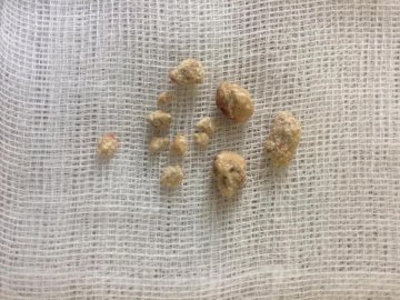 Волинські лікарі видалили пацієнтці великий камінь нирки через маленький розріз шкіри. ФОТО