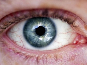 Чому лопають судини в оці та що з цим робити