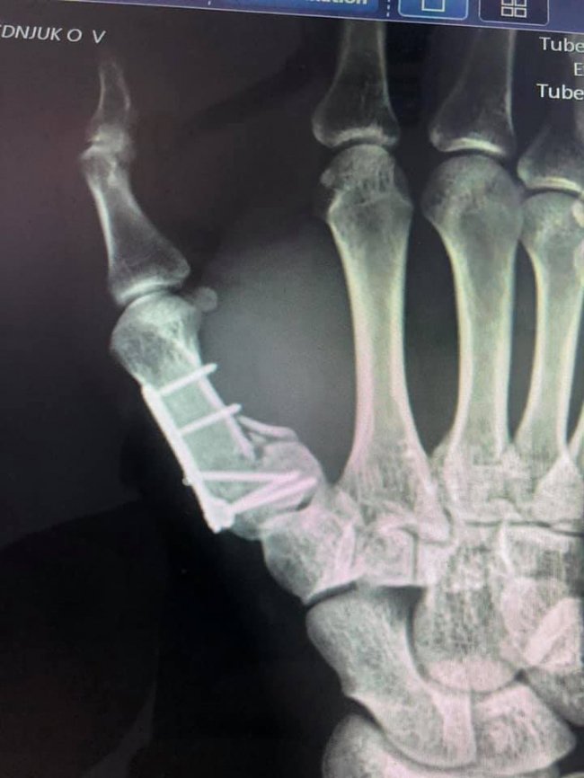 Волинські лікарі прооперували пацієнта, який впав з висоти зросту 