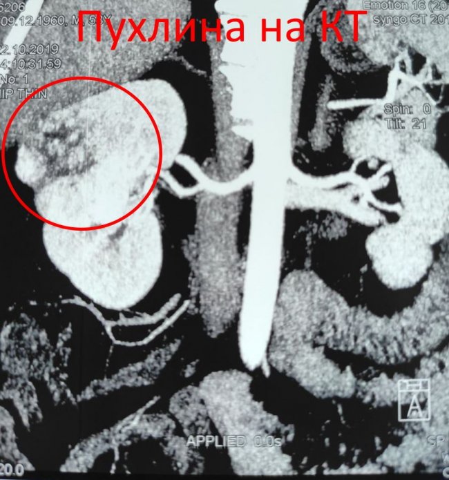 Волинські медики одномоментно провели одразу дві операції пацієнту з пухлиною нирки. ФОТО