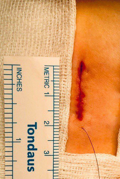 У волинській лікарні провели складну операцію 2-річному пацієнту 