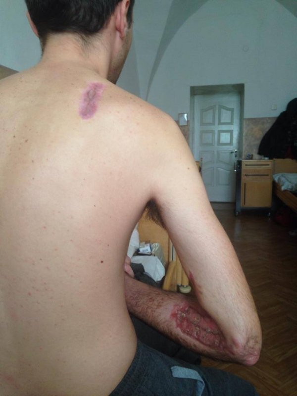 Бійцю з Нововолинська терміново необхідна реабілітація. ФОТО