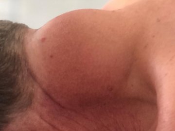 Ходив так три роки: на Волині чоловіку видалили чималу пухлину з шиї. ФОТО 18+ 