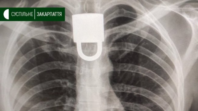 В Ужгороді чоловік жив з виделкою у шлунку три місяці. ФОТО