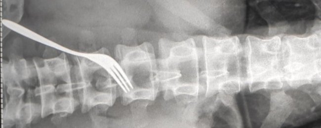 В Ужгороді чоловік жив з виделкою у шлунку три місяці. ФОТО