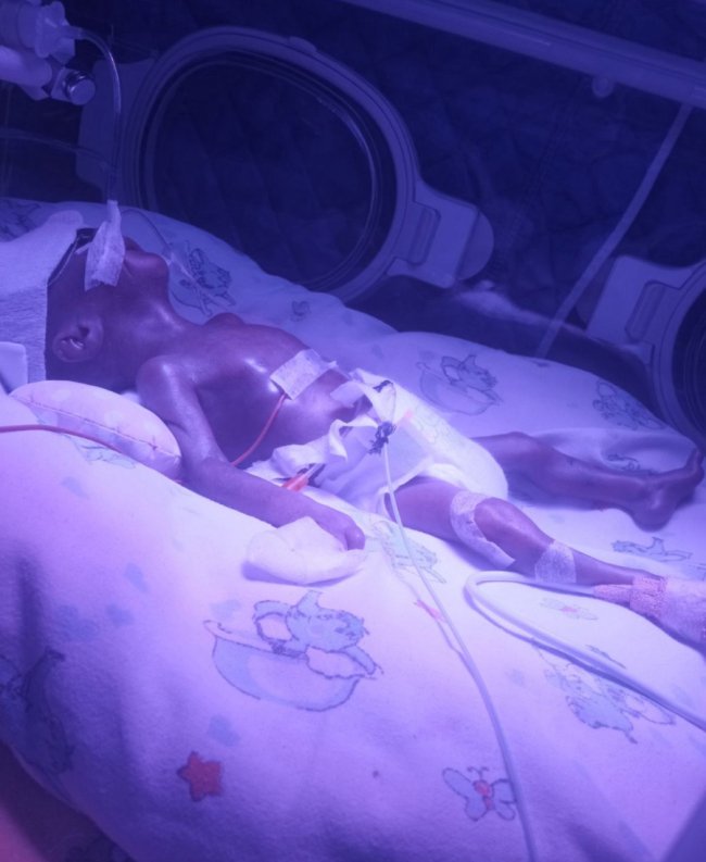 У Волинському перинатальному центрі розповіли історію дівчинки, яка народилася з вагою 640 грамів