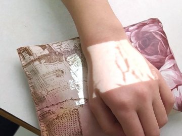 Ін’єкції майже безболісно: у дитячій поліклініці Луцька з’явився венозний сканер 