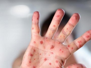 У Луцьку менше 5% дітей до 6 років «захищені» від кору