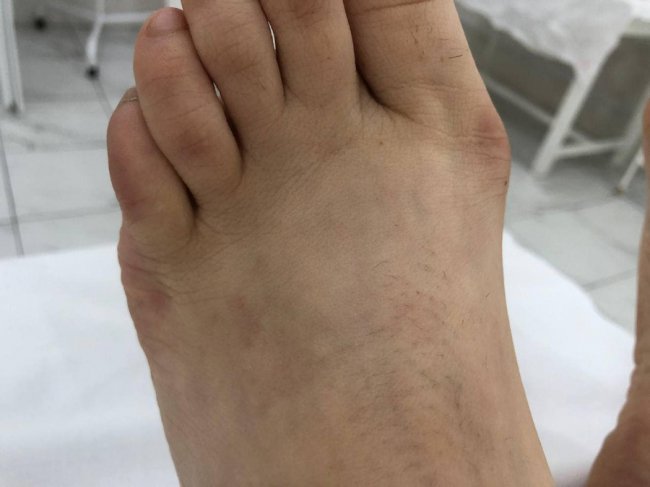 Лікарі прооперували 24-річну волинянку, у якої були викривлені пальці обох стоп 