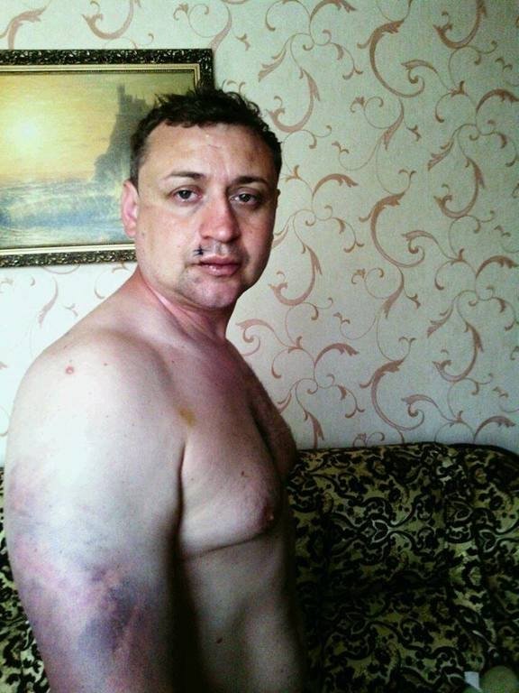 Колишній полонений «ДНР» показав, як знущалися терористи. ФОТО