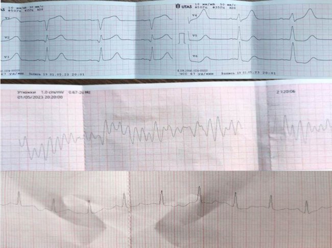 На Волині медики повернули до життя 68-річну жінку після зупинки серця