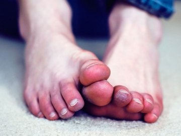 Волинянин отримав переохолодження і відморозив кінцівки