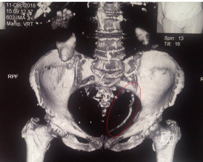 Медики роздробили гігантський камінь у сечоводі волинянки