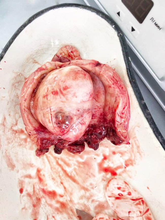 Жінці з Америки на Волині вирізали величезну пухлину. ФОТО 18+