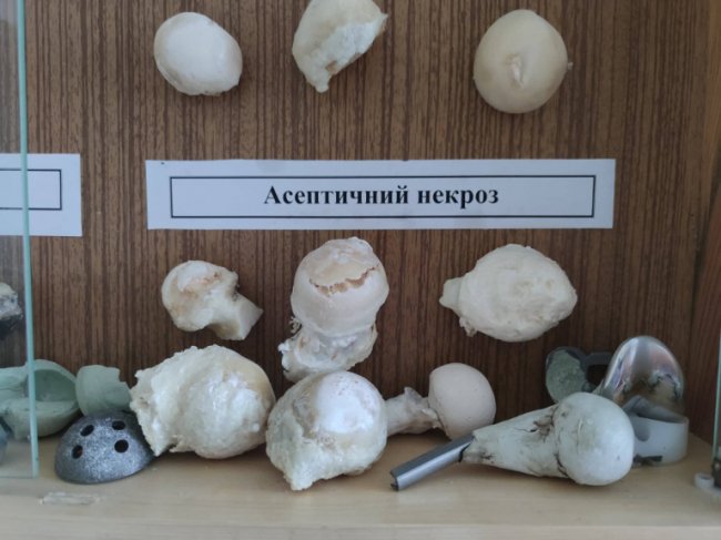 У Луцьку чоловіку зробили інноваційну операцію із заміни тазостегнових суглобів