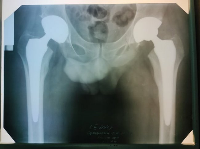 У Луцьку чоловіку зробили інноваційну операцію із заміни тазостегнових суглобів