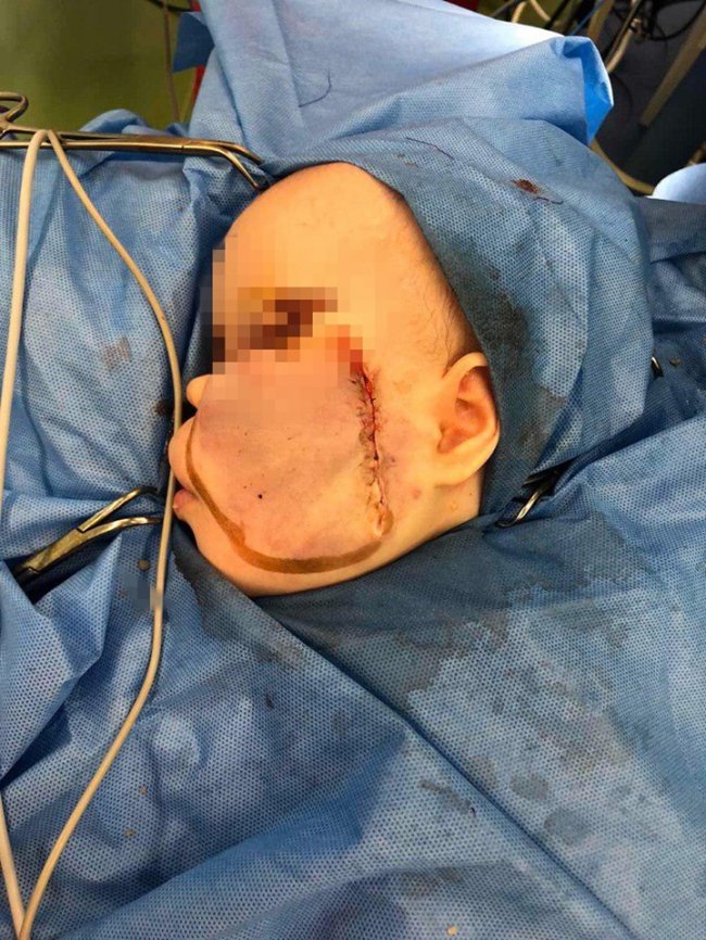 Хірург з Волині видалив з обличчя немовляти величезну пухлину. ФОТО