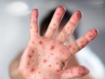 Хворих на кір в Україні більше, ніж в усій Європі