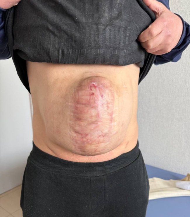 Волинські медики зробили складну унікальну операцію пацієнту з гігантською грижею. ФОТО